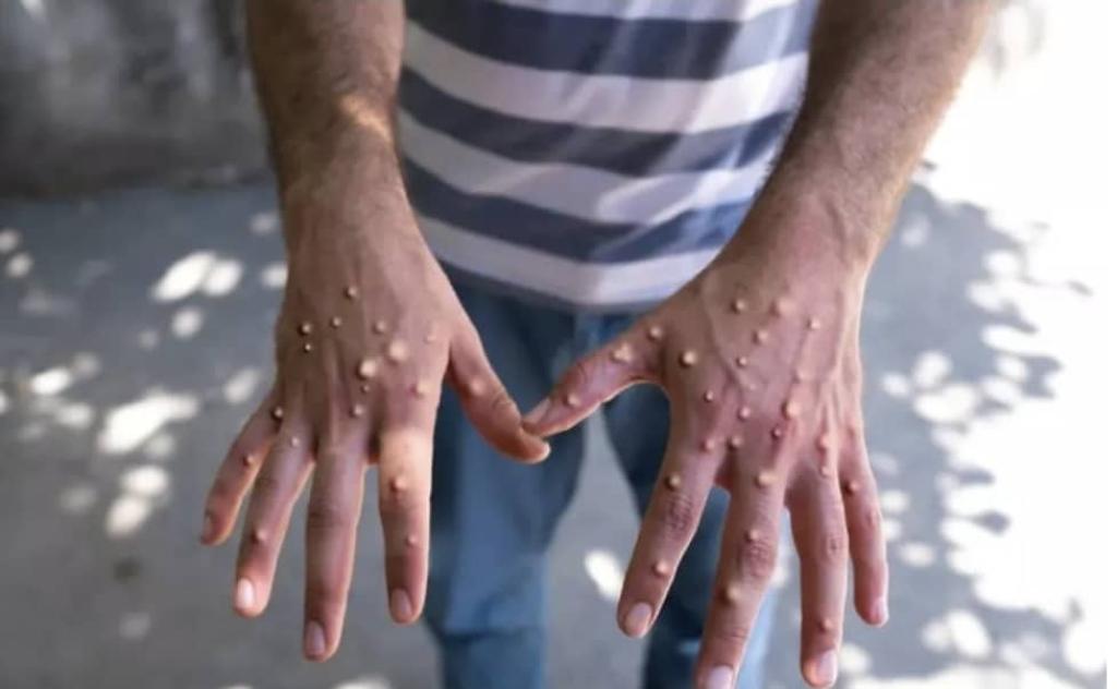 MPOX : plus de 380 cas confirmés en Guinée