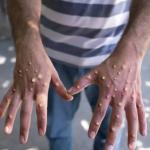 MPOX : plus de 380 cas confirmés en Guinée