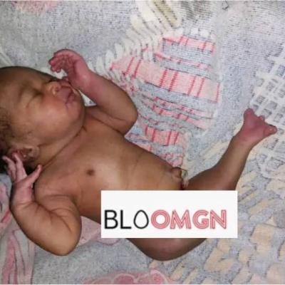 Faranah : Naissance d'un bébé avec malformation rare