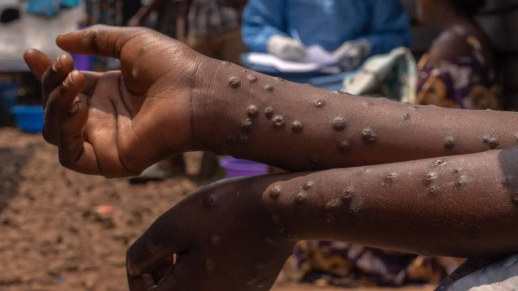Santé : un spécialiste interpelle les autorités sur la gestion de la variole de singe appelée Mpox
