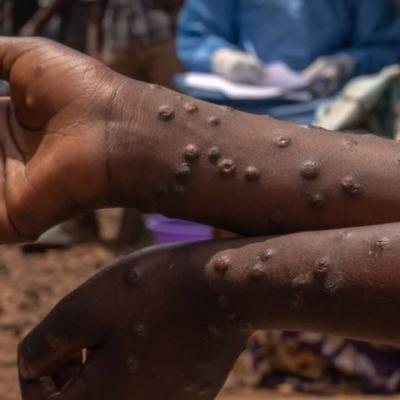Santé : un spécialiste interpelle les autorités sur la gestion de la variole de singe appelée Mpox