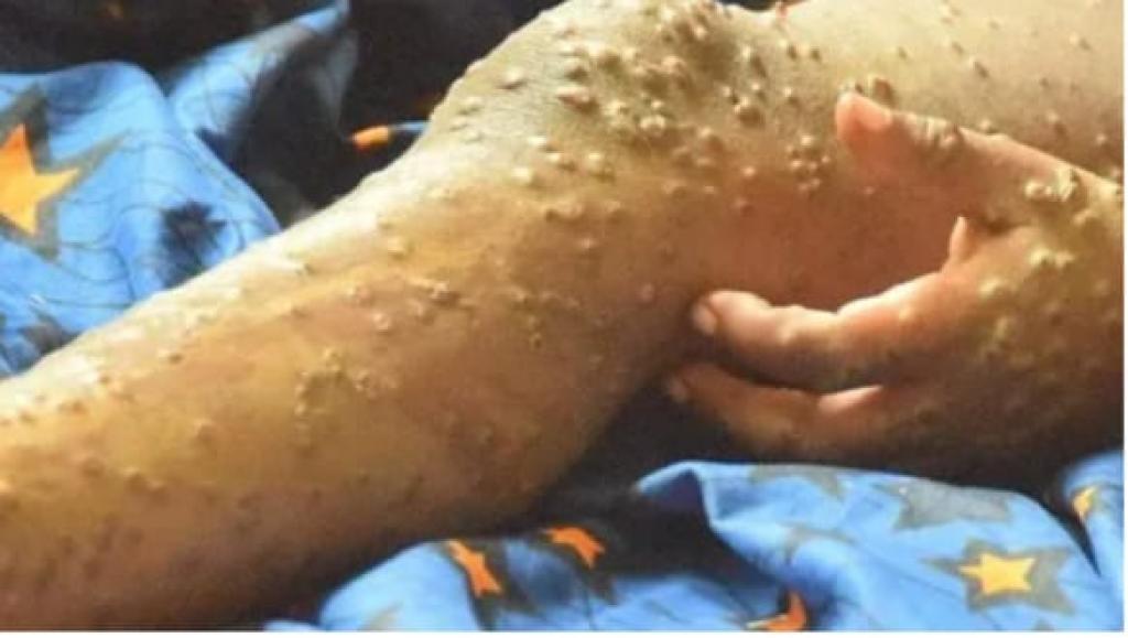 RDC/Kinshasa : 20 décès liés au Mpox en une semaine